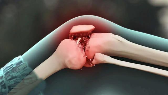 pengertian-osteoarthritis
